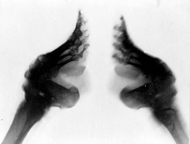 Radiographie de pieds bandés